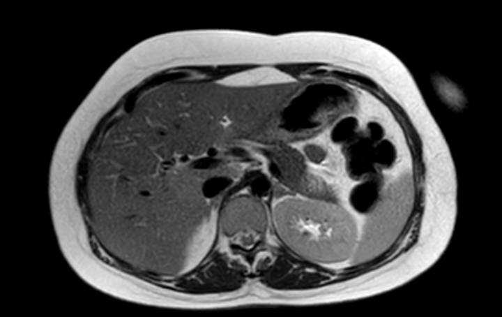 Colon adenocarcinoma with Krukenberg tumors, advanced pregnancy (Radiopaedia 67279-76645 Axial T2 63).jpg