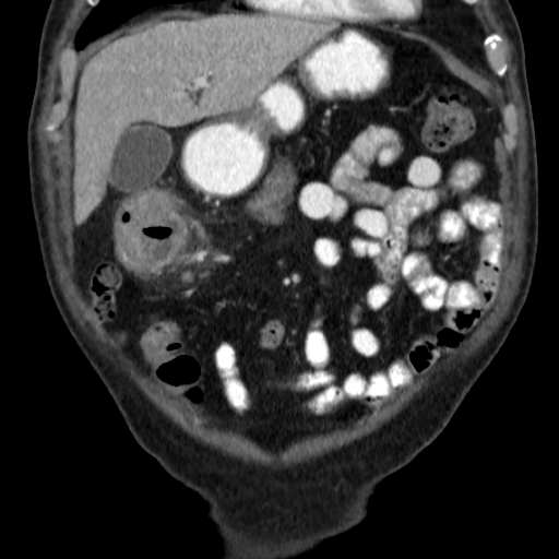 File:Colon cancer with duodenal invasion (Radiopaedia 16278-15958 B 15).jpg