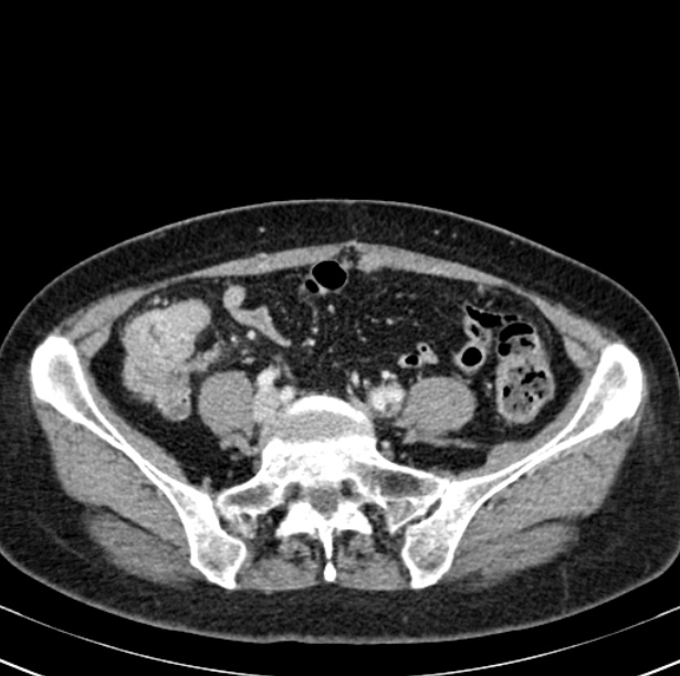 Colon carcinoma with hepatic metastases (Radiopaedia 29477-29961 A 80).jpg
