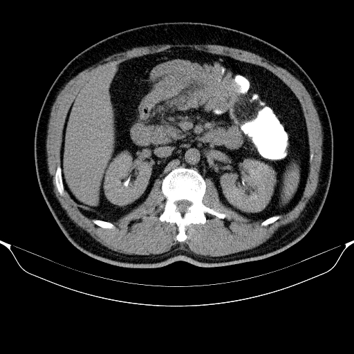 Colonic lipoma with colo-colic intussusception (Radiopaedia 58944-66200 Axial C+ rectal 21).jpg