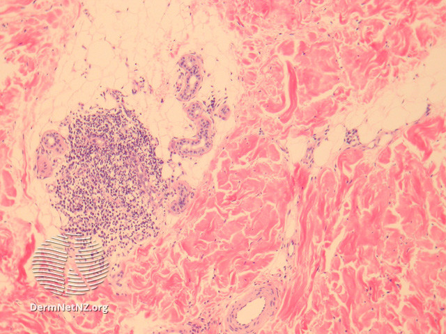 File:Figure 3 (DermNet NZ pathology-e-lichen-striatus-figure-3).jpg