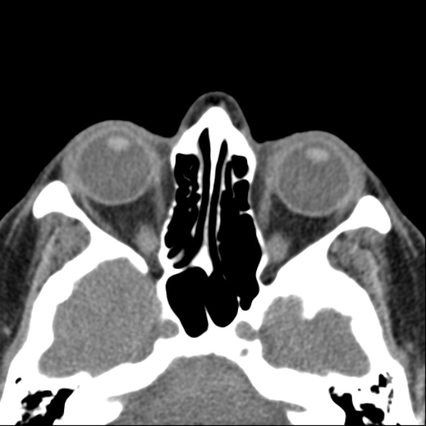Nasolabial cyst (Radiopaedia 33987-35205 Axial non-contrast 32).jpg