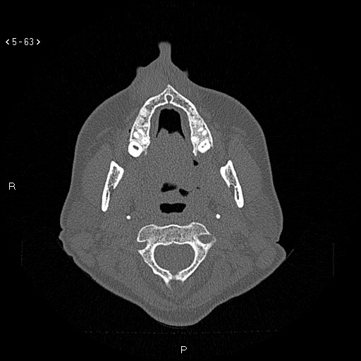 Nasolabial cyst (Radiopaedia 75125-86194 Axial bone window 24).jpg