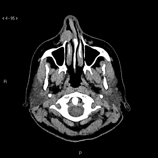 Nasolabial cyst (Radiopaedia 75125-86194 Axial non-contrast 57).jpg