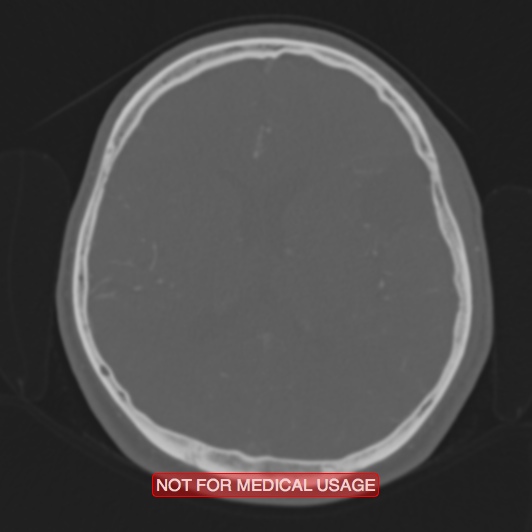 Nasopharyngeal carcinoma recurrence - skull base destruction (Radiopaedia 29107-29490 Axial bone window 45).jpg
