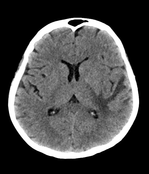 File:Nasopharyngeal carcinoma with cerebral abscess (Radiopaedia 43018-46275 Axial non-contrast 29).png