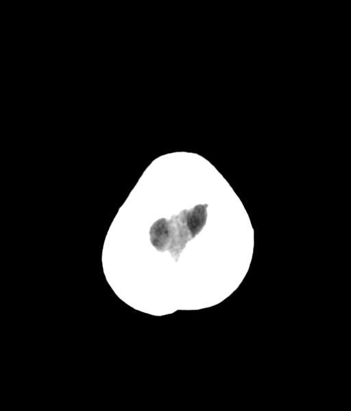 File:Nasopharyngeal carcinoma with cerebral abscess (Radiopaedia 43018-46275 Axial non-contrast 50).png