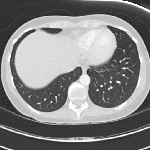 File:Necrobiotic pulmonary nodules - Crohn disease (Radiopaedia 20723-20631 Axial lung window 112).jpg