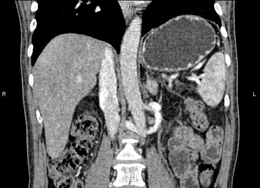 Necrotizing pancreatitis (Radiopaedia 87796-104248 F 38).jpg