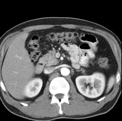 File:Necrotizing pancreatitis with acute necrotic collection (Radiopaedia 14470-14417 B 14).jpg