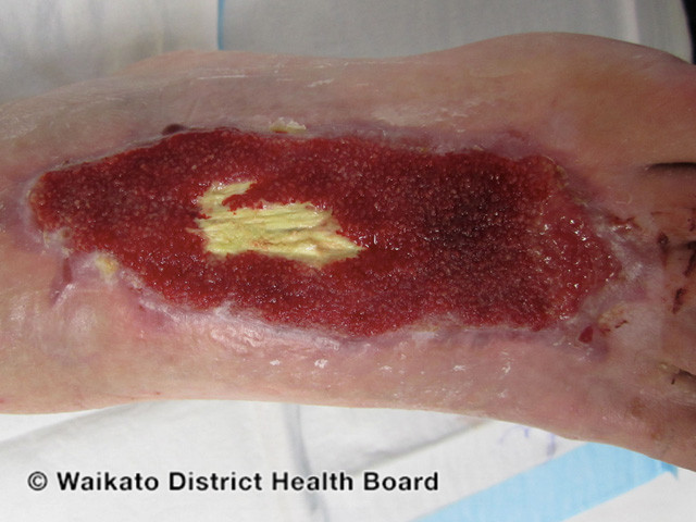 File:Negative-pressure wound therapy (DermNet NZ procedures-w-vac-wound1).jpg