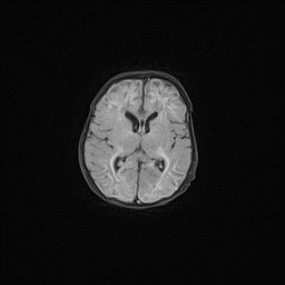 File:Neonatal hypoxic-ischemic encephalopathy (Radiopaedia 41406-44277 Axial FLAIR 9).jpg