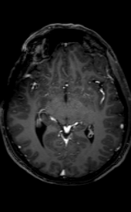 Neuro-Behçet disease (Radiopaedia 90112-107294 Axial T1 C+ 137).jpg