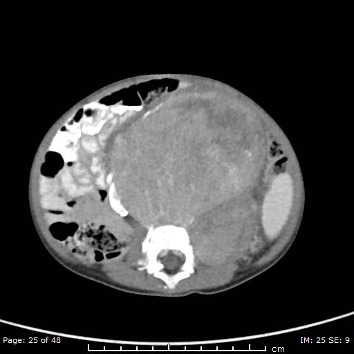 File:Neuroblastoma (Radiopaedia 41472-44355 A 25).jpg