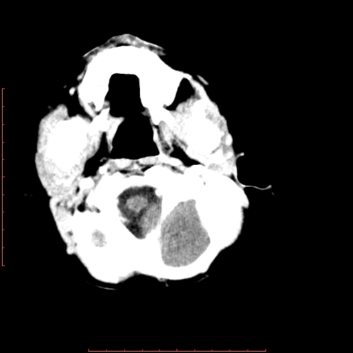 File:Neuroblastoma skull metastasis (Radiopaedia 56053-62683 Axial +Contrast 3).jpg