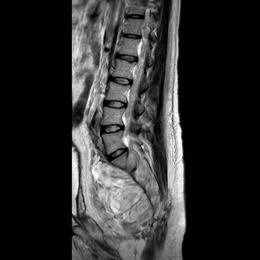 File:Neurofibromatosis type 1- extensive spinal involvement and Christmas tree sign (Radiopaedia 60610-68332 Sagittal T2 9).jpg