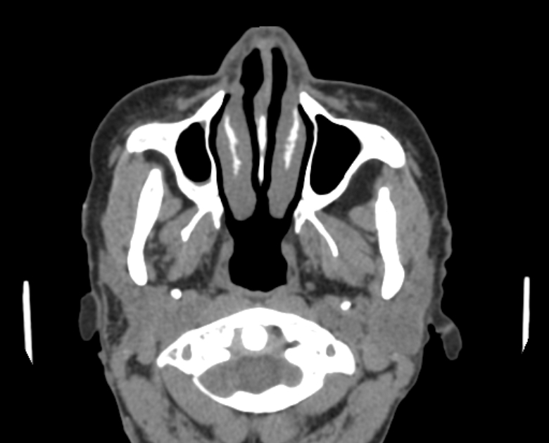 Neurofibromatosis type 1- orbital manifestations (Radiopaedia 49391-54511 Axial non-contrast 19).jpg