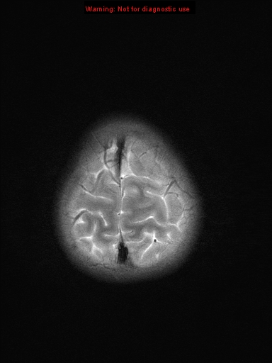 File:Neurofibromatosis type 1 with optic nerve glioma (Radiopaedia 16288-15965 Axial T2 3).jpg