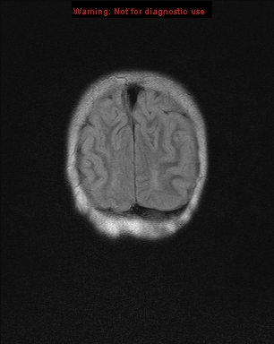 File:Neurofibromatosis type 1 with optic nerve glioma (Radiopaedia 16288-15965 Coronal FLAIR 2).jpg