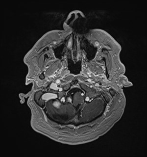 Neurofibromatosis type 2 (Radiopaedia 79097-92049 Axial T1 C+ 34).jpg