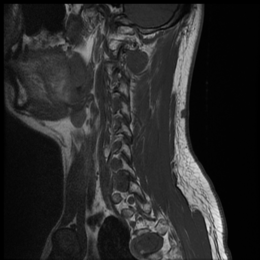 File:Neurofibromatosis type 2 (spinal manifestations) (Radiopaedia 53943-60070 Sagittal T1 12).png