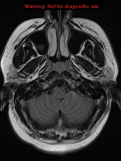 File:Neuroglial cyst (Radiopaedia 10713-11184 Axial FLAIR 20).jpg