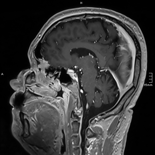 Neurosarcoidosis - involvement of the mesial temporal lobes (Radiopaedia 67429-76820 Sagittal T1 C+ 93).jpg