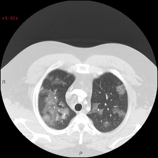 File:Non-specific interstitial pneumonitis (Radiopaedia 27044-27222 Axial lung window 44).jpg