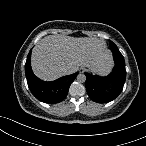 Normal CT chest- adult female (Radiopaedia 52522-58428 Axial non-contrast 107).jpg