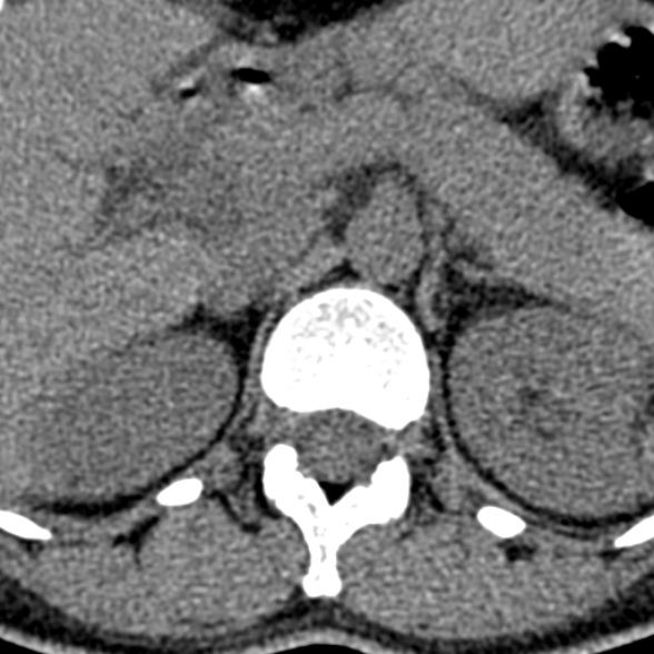 Normal CT lumbar spine (Radiopaedia 53981-60118 Axial non-contrast 12).jpg