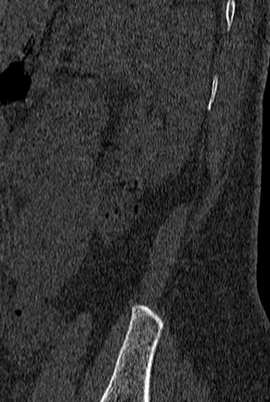 File:Normal CT lumbar spine (Radiopaedia 53981-60118 Sagittal bone window 101).jpg