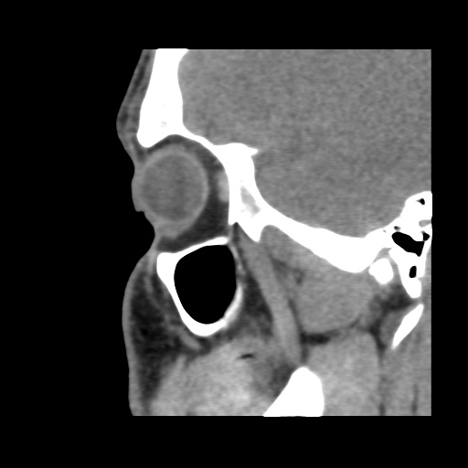 Normal CT paranasal sinuses (Radiopaedia 42286-45390 F 113).jpg