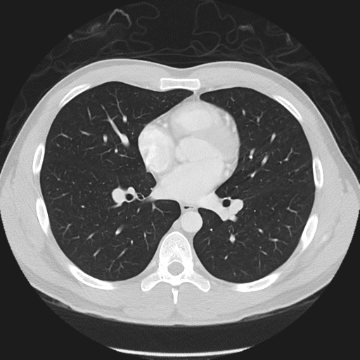 Normal CT pulmonary veins (pre RF ablation) (Radiopaedia 41748-44702 Axial lung window 28).png