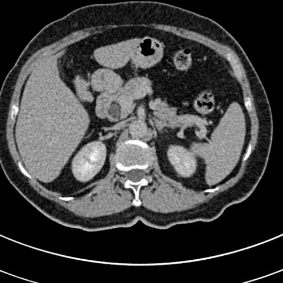 File:Normal CT split bolus study of the renal tract (Radiopaedia 48631-53634 Axial split bolus 36).jpg
