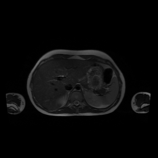 File:Normal MRI abdomen in pregnancy (Radiopaedia 88001-104541 Axial T2 12).jpg