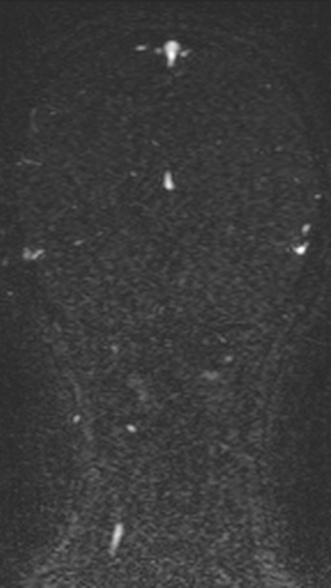 Normal MRI brain with MRV- teenager (Radiopaedia 49425-54553 Coronal MRV 181).jpg
