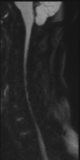 File:Normal MRI cervical spine (infection protocol) (Radiopaedia 53916-60039 Sagittal DWI 23).png
