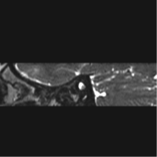 Normal MRI internal auditory canal (Radiopaedia 41613-44525 C 90).png