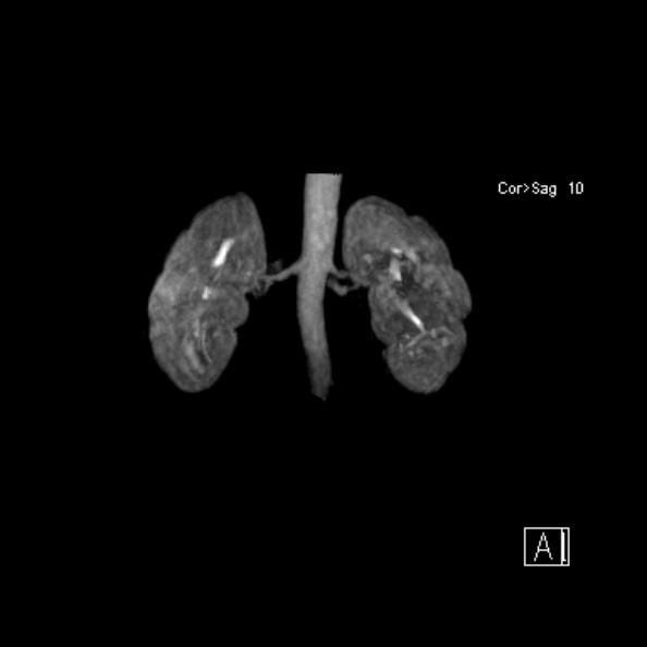 File:Normal MR renal angiogram (Radiopaedia 25829).jpg