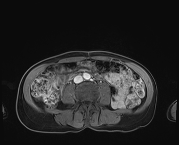 Normal adrenal glands MRI (Radiopaedia 82017-96004 K 63).jpg