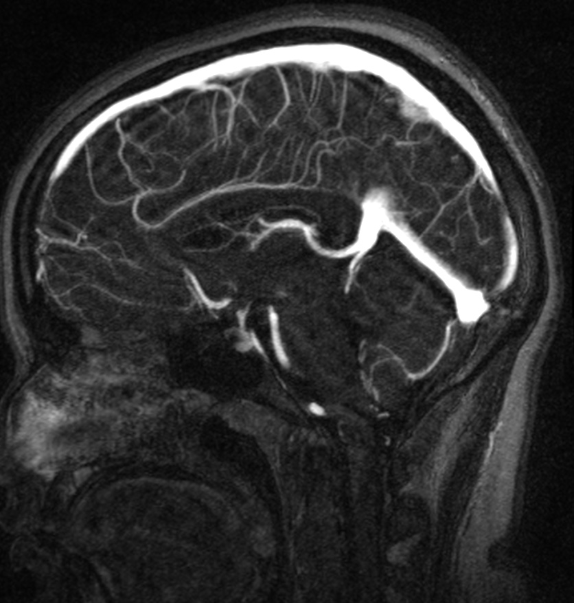 Normal brain MRI and venogram (Radiopaedia 39554-41862 Sagittal MRV 33).jpg