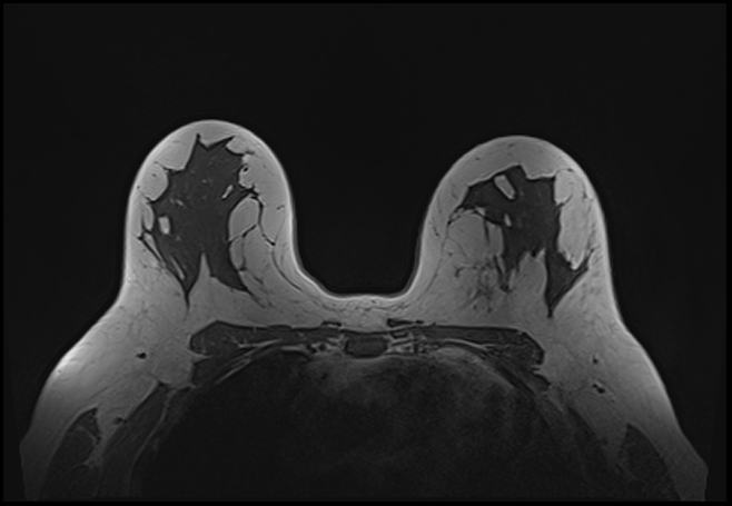 File:Normal breast MRI - dense breasts (Radiopaedia 80454-93850 Axial T1 137).jpg