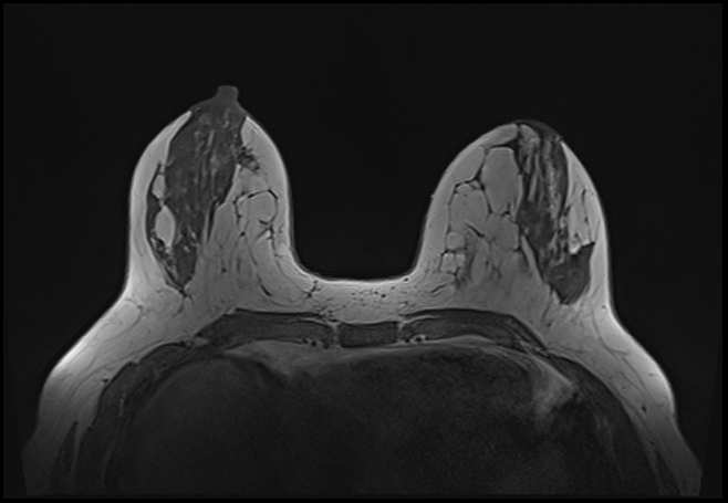 File:Normal breast MRI - dense breasts (Radiopaedia 80454-93850 Axial T1 82).jpg