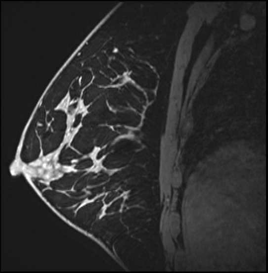 Normal breast MRI - dense breasts (Radiopaedia 80454-93850 I 117).jpg