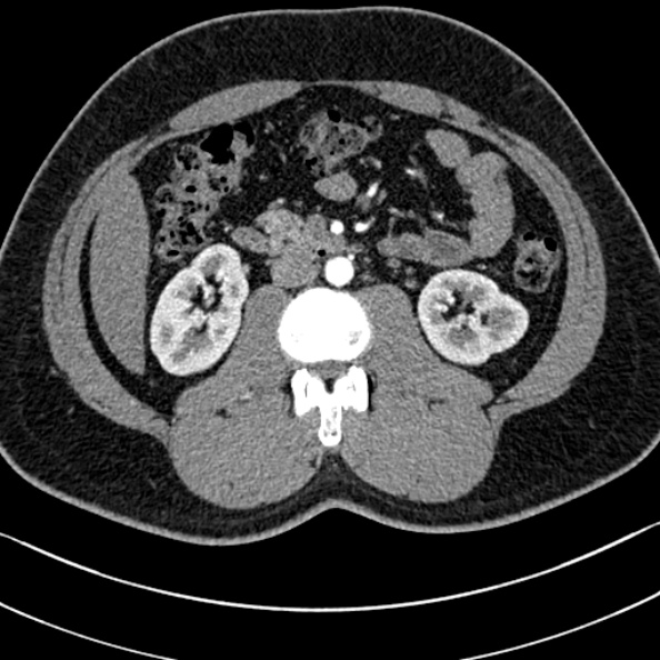 Normal kidneys on 4-phase CT study (Radiopaedia 25889-26038 B 52).jpg