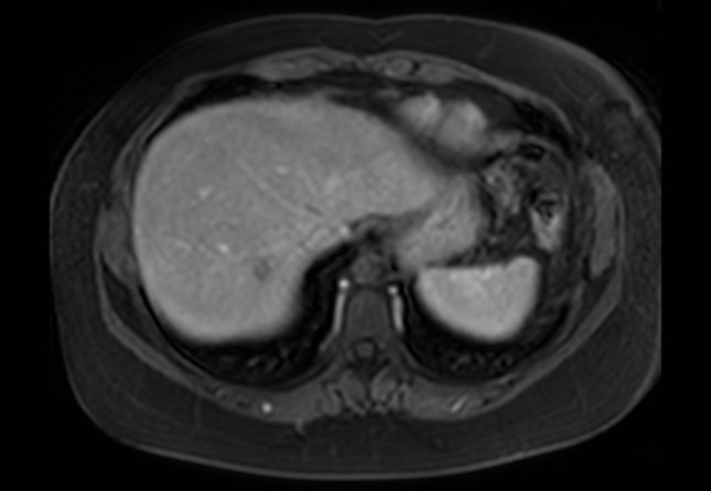 Normal liver MRI with Gadolinium (Radiopaedia 58913-66163 J 63).jpg