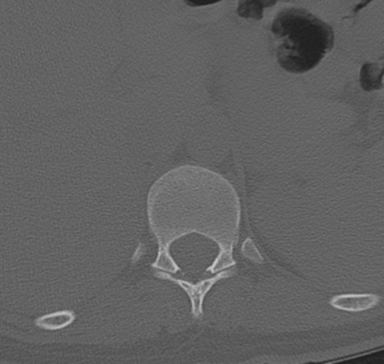 File:Normal lumbosacral CT (Radiopaedia 37923-39867 Axial bone window 8).png