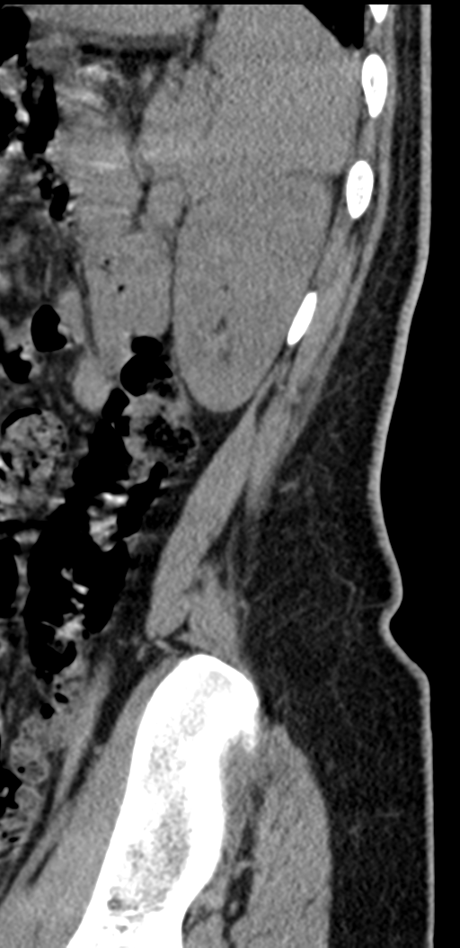 Normal lumbosacral CT (Radiopaedia 37923-39867 E 12).png