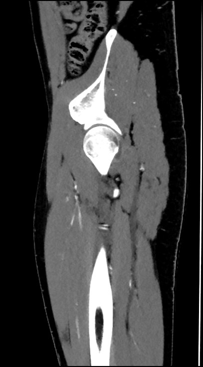 Normal pelvis CT angiogram (Radiopaedia 84966-100481 C 22).jpg