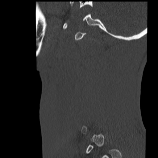 File:Normal trauma cervical spine (Radiopaedia 41017-43760 Sagittal bone window 44).png